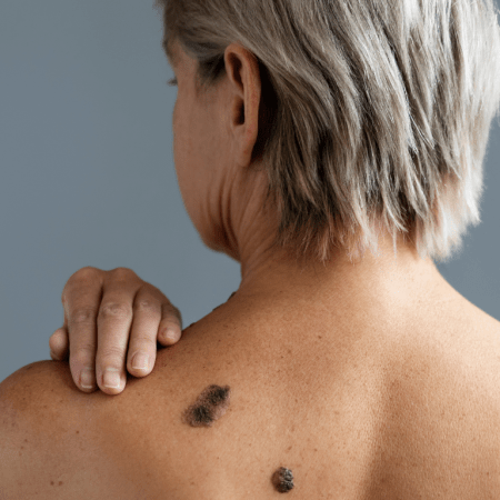 Lesão de pele suspeita observada com a regra do ABCDE do melanoma.