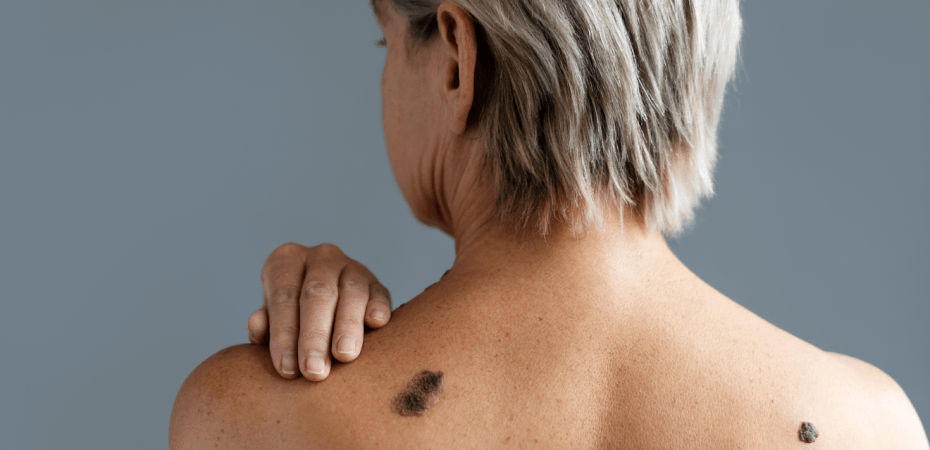 Lesão de pele suspeita observada com a regra do ABCDE do melanoma.